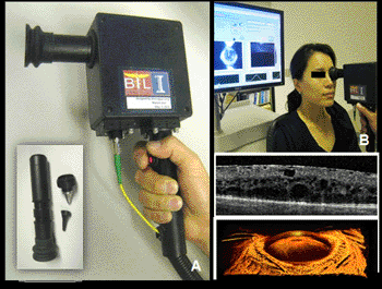 Imagen: Un prototipo inicial del escáner portátil tiene OCT y capacidades de video y puntas intercambiables para los ojos, oídos, piel y tejido oral. A modo de ejemplo, el dispositivo visualiza la retina y las estructuras oculares anteriores (parte interior derecha) (Fotografía cortesía de la Universidad de Illinois).